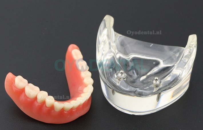 Tandentandenmodel Overdenture Inferieur met 2 implantaten Studiedemo Model 6002 01